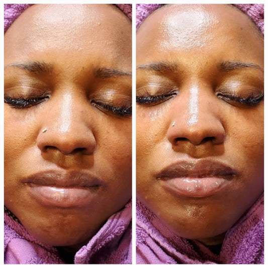 Dermaplane Facial